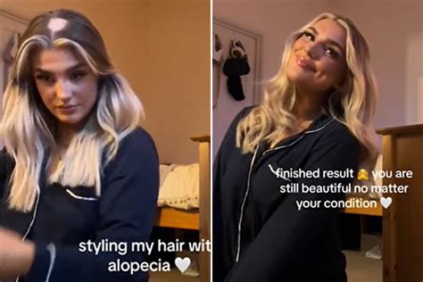 Woman Shares Her Hair Styling Hacks to Hide Alopecia